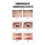 Laser Wrinkle Remover Factory - 1470nm Face Lifting Anti-wrinkle Machine