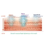 Erbium Laser Manufacturer - 4D Pro Fractional Vaginal Tightening Scar Removal 2940nm Er Yag