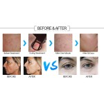 Fractional CO2 Laser Supplier - 2024 Huamei New Acne Scar Removal Skin Rejuvenation Portable