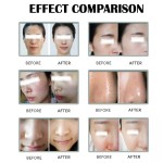 RF Machine Manufacturer - Most Advanced Fractional Radio Frequency Popular Face Lifting Machine