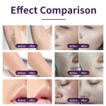 Laser Hair Removal Machine Supplier - Huamei 2023 New 2 In1 3 Wavelength 1064 755 808 Diode Ipl