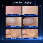 Diode Laser Manufacturer - 2024 Huamei 4 in 1 980nm Spider Vein Removal Nail Fungus Removal