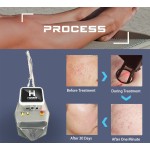 Fractional CO2 Laser Supplier - 2024 Huamei New Acne Scar Removal Skin Rejuvenation Portable