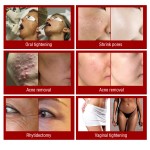 Erbium Laser Factory - 2940nm 4D Pro Vaginal Rejuvenation Tightening Scar Removal 1064nm