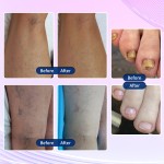 Skin Cooling Machine Supplier - Zimmer Cryo Cold air Skin Cooling System for Laser Treatment