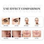 Laser Skin Tightening Supplier - Most Popular 1470nm Diode Fractional Wrinkle Removal Machine