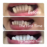 Teeth Whitening Dry Strips Manufacturer - Private Label Wholesale Professional Home Use Dental