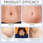 Skin Repair Cream Supplier - Wholesale Healthcare Supply Skin Repair Cream for Stretch Mark Scar Removal