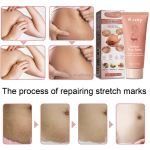 Stretch Mark Cream Manufacturer - Effective Body Cream for Stretch Mark and Pregnancy Scar Removal Personal Care
