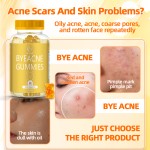 祛痘软糖厂家 - 草本补充剂红肿消除