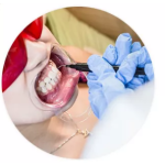 Gum Barrier Factory - Professional Teeth Whitening Protector