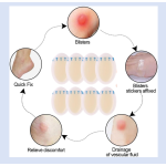 Hydrocolloid Wound Dressing Manufacturer - Self-adhesive Waterproof Bed Sore Care