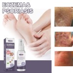 EELHOE Wholesale OEM Health Care Supplies Psoriasis Cream Eczema Herbals Spray for Skin Care