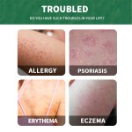 South Moon Ultra Gentle Reduce Inflammation Eliminate Redness and Swelling Calming Cream Suit for Sensitive Skin Psoriasis Cream