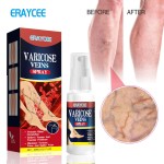 Varicose Vein Spray Vasculitis Phlebitis Spider Legs Soothing Blood Vessel Bulging Redness Leg Body Care Veins Spray