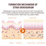 Stretch Mark Serum Supplier - Rose Removes Postpartum Obesity Repair