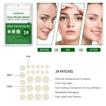 Acne Patch Factory - West&Month Acne Pimple Remover Waterproof Stickers