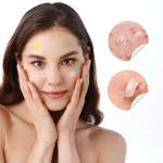 Acne Pimple Patch Manufacturer - Invisible Blemish Hydrocolloid Healing