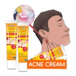 Acne Removal Cream Manufacturer - Oil Control Sebum Inhibition Pore Cleansing