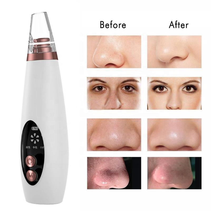 Blackhead Vacuum Remover