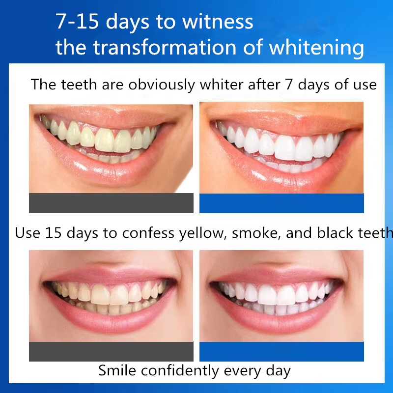 Teeth Whitening Kits